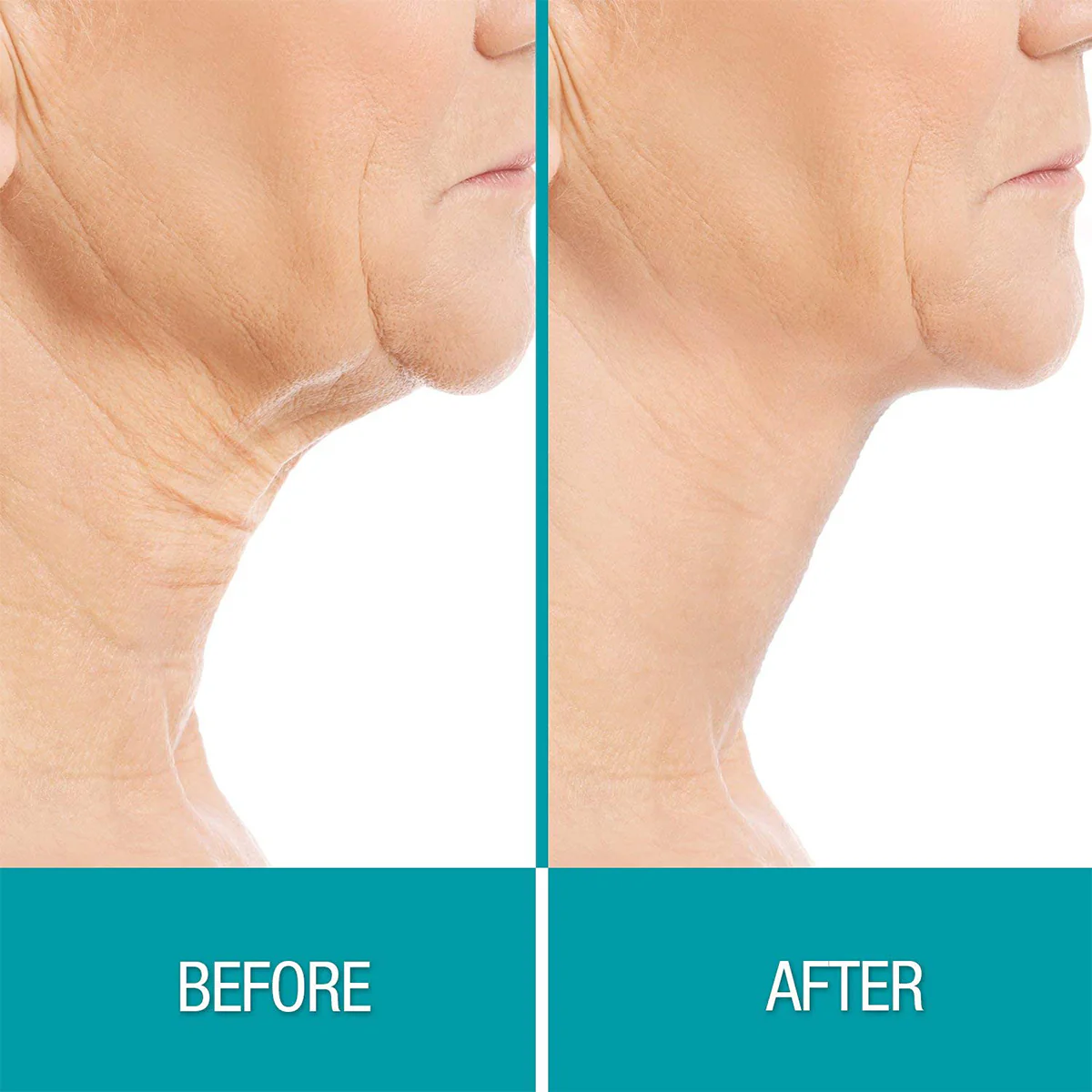 Fat Freezer Chin and Neck Sculpting System - Image 2