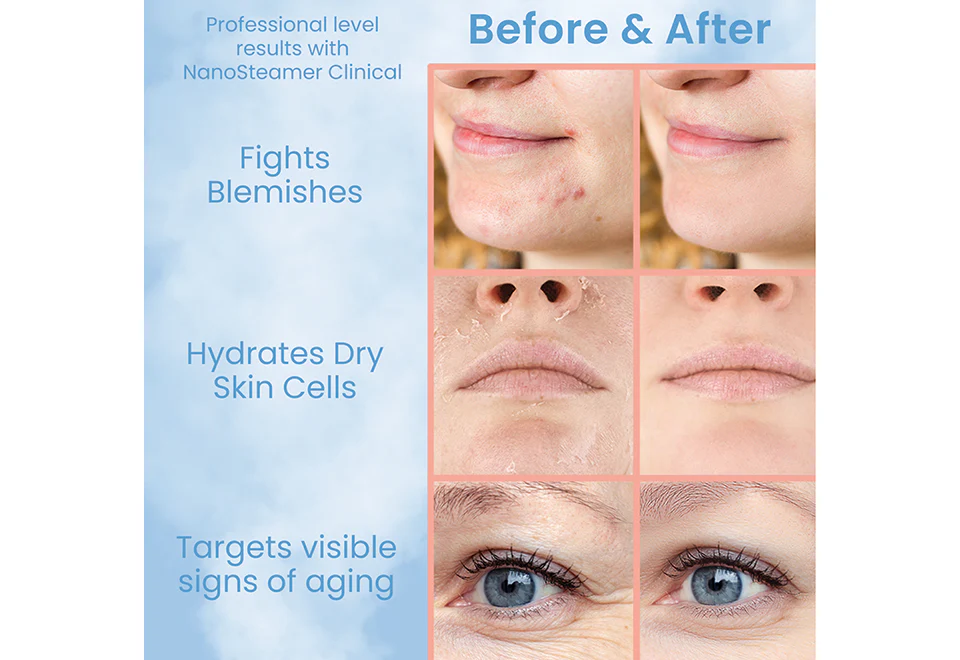 Professional Grade Facial Steamer - Image 3