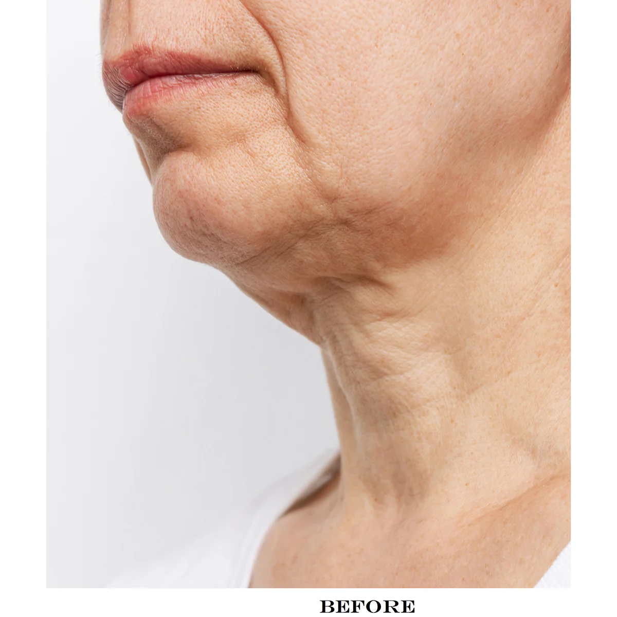 Wrinkle Reducing Neck Therapy Device - Image 5
