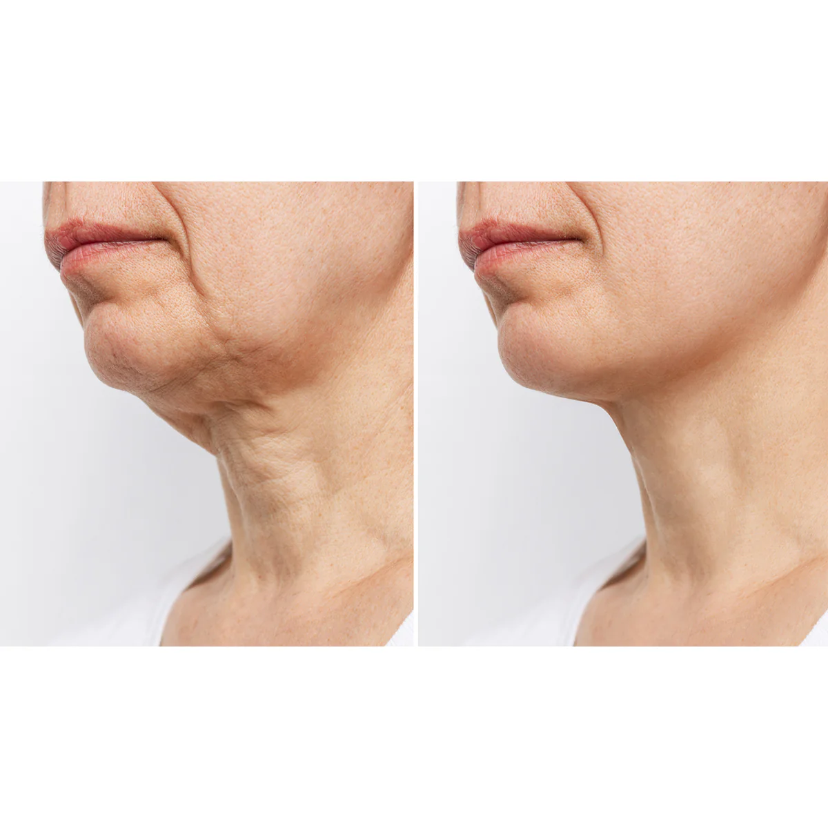 Wrinkle Reducing Neck Therapy Device - Image 7